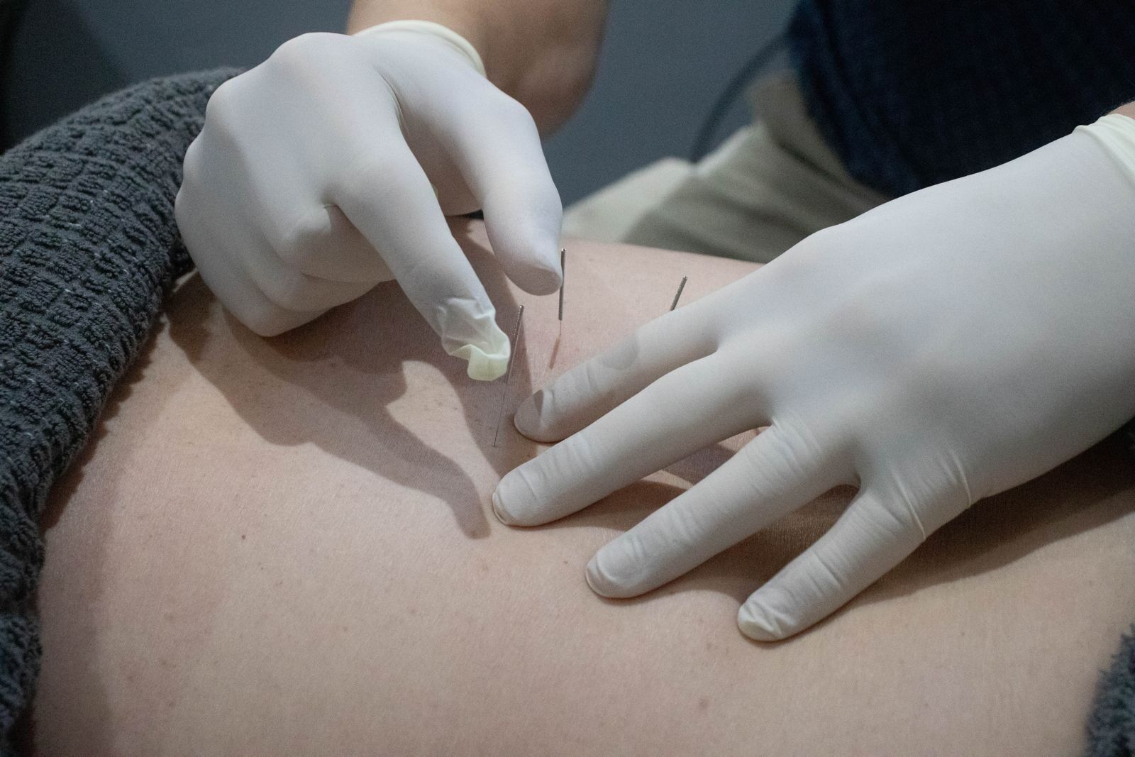 Dry Needling at Peak Physiotherapy, Mayville, Pretoria